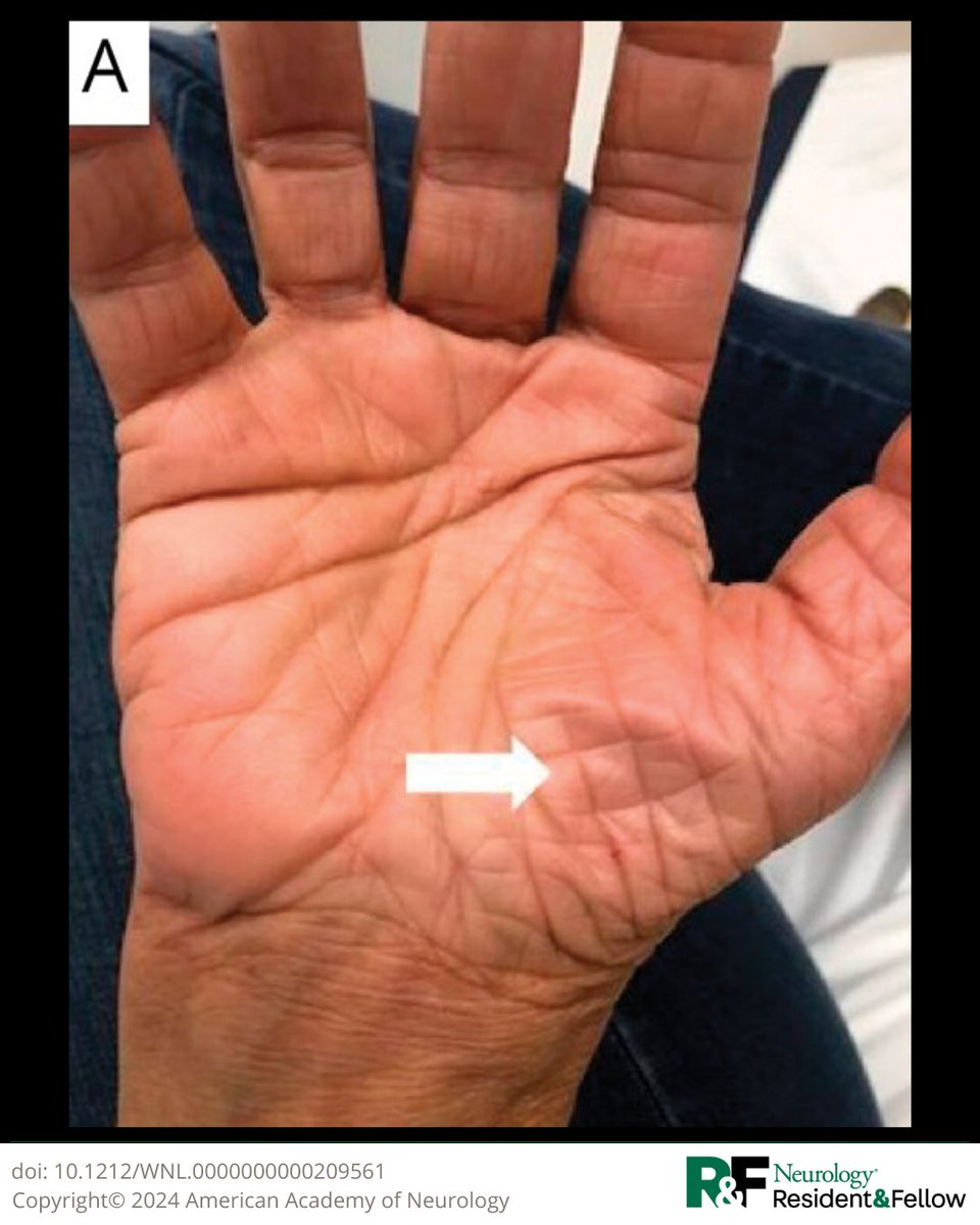 A 50-year-old woman presented with painless progressive thumb abduction weakness and atrophy of the hand, selectively involving the thenar muscles. #NeurologyRF 🧵