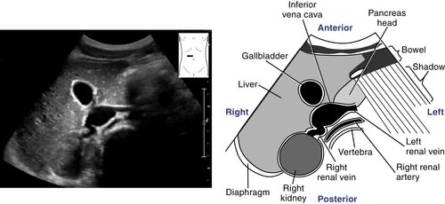 NephroP's tweet photo. Abdominal aorta and IVC #POCUS #anatomy 
#MedEd #Nephpearls #FOAMcc 
Courtesy: Radiologykey .com https://t.co/KDLuNd2IOD