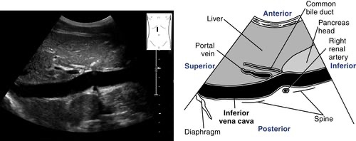 NephroP's tweet photo. Abdominal aorta and IVC #POCUS #anatomy 
#MedEd #Nephpearls #FOAMcc 
Courtesy: Radiologykey .com https://t.co/KDLuNd2IOD