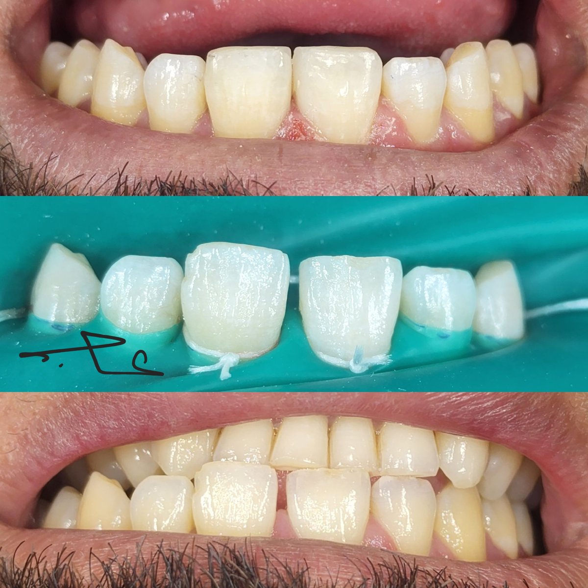 Diastema closure case!
Done by layering technique with impress composite from <a href="/ivoclar/">Ivoclar</a>.

حالة إغلاق فراغ بين سنيين اماميين باستخدام حشوات تجميلية بطريقة تحفظية ١٠٠%