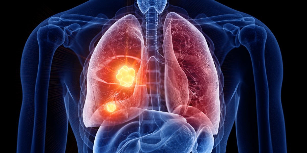 A new AI-driven study reveals key indicators of lung cancer outcomes. Learn more with lead author, Tafadzwa Chaunzwa, MD, and senior author Hugo Aerts, PhD, from Mass General Brigham's Artificial Intelligence in Medicine (AIM) Program. spklr.io/6010SWVm