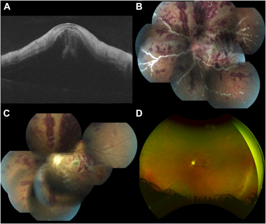 Ophthalmology tweet media