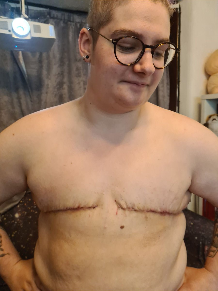 CaptainWhelmed's tweet photo. I'm just a few days late but bloody hell, I'm officially two years post top surgery, how mad is that ??

Left: July 2022 (12 days post op) Right: June 2024 (1 year 11 months) https://t.co/bFxJF9EJbK