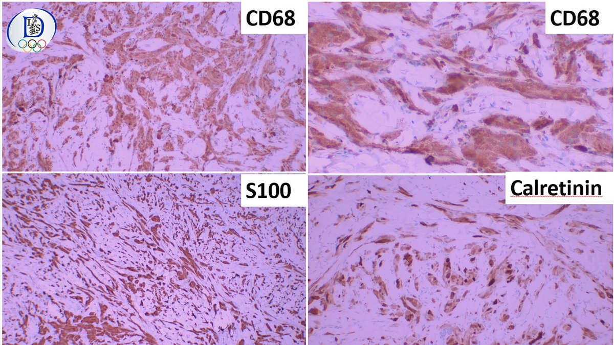 Int Soc Dermpath (@intsocdermpath) on Twitter photo #ISDP #olympics
Spot diagnosis
Case 6 - <a href="/JCandidoXavier/">Jose Candido</a>
GRANULAR CELL TUMOR
•Benign neuroectodermal tumor
•Large cells with abundant and granular cytoplasm
•Synonym: Abrikossoff tumor
•Pseudoepitheliomatous hyperplasia can be prominent
#path #pathology #dermatology #ISDP #olympics
Spot diagnosis
Case 6 - <a href="/JCandidoXavier/">Jose Candido</a>
GRANULAR CELL TUMOR
•Benign neuroectodermal tumor
•Large cells with abundant and granular cytoplasm
•Synonym: Abrikossoff tumor
•Pseudoepitheliomatous hyperplasia can be prominent
#path #pathology #dermatology