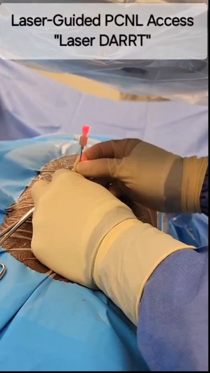 Nazih Paul Khater, MD, FACS (@nazihkhatermd) on Twitter photo Honored & thrilled for this <a href="/Endo_Society/">Endourological Society</a> podcast invitation to talk about "The DARRT technique for PCNL access" & discuss with Dr.Schwartz!🎙️
<a href="/JEndourology/">Journal of Endourology</a>
Goals 🎯:
1️⃣Easy to learn
2️⃣Minimal☢️
3️⃣Safe
4️⃣Lowest cost
5️⃣Efficient 💯
home.liebertpub.com/lpages/richard…
<a href="/SES_AUA/">Southeastern Section</a> <a href="/AmerUrological/">Amer. Urol. Assn.</a> Honored & thrilled for this <a href="/Endo_Society/">Endourological Society</a> podcast invitation to talk about "The DARRT technique for PCNL access" & discuss with Dr.Schwartz!🎙️
<a href="/JEndourology/">Journal of Endourology</a>
Goals 🎯:
1️⃣Easy to learn
2️⃣Minimal☢️
3️⃣Safe
4️⃣Lowest cost
5️⃣Efficient 💯
home.liebertpub.com/lpages/richard…
<a href="/SES_AUA/">Southeastern Section</a> <a href="/AmerUrological/">Amer. Urol. Assn.</a>