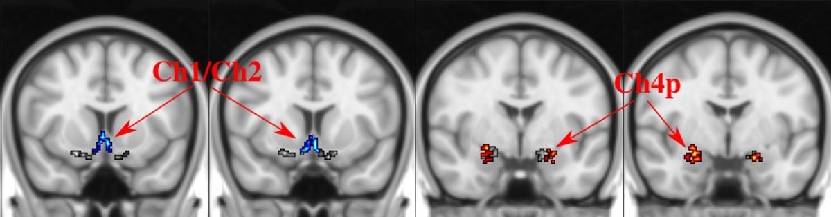 ADNeT_Australia's tweet photo. Results of a new study show that atrophying of the basal forebrain, a key brain region for learning and memory and part of the cholinergic system, could indicate the presence of Alzheimer's disease well before symptoms occur. ➡️ https://t.co/vatvNlamCJ @CSIRO @TheFlorey @UniMelb https://t.co/SPTyvE4YvC