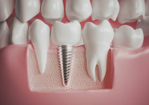 Do you need a filling replacement or a dental implant? Our specialists at Elm Dental Care have the expertise and technology to restore your smile to its natural beauty. bit.ly/3It3ZQC