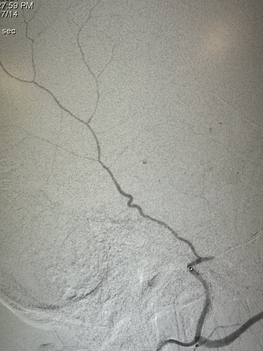 PenNeuro's tweet photo. US HCPs: Stable access for ever-evolving therapies: #MIDWAY 43 tracking to MMA origin as stand-alone support for ONYX embolization of frontal branch. Courtesy of @DennysReyesMD! 

Rx only. Risk: https://t.co/hzWEQEPOqr Clinical results may vary. https://t.co/kAEbCgjvlF