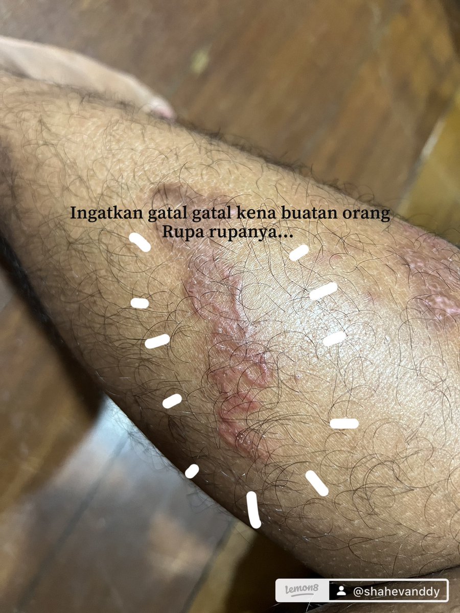 ShahEvanddy's tweet photo. Jangan pergi pantai kalau kau taknak kena gatal gatal macam ni 😥 Komen nak for thread https://t.co/BCRtj72OIb