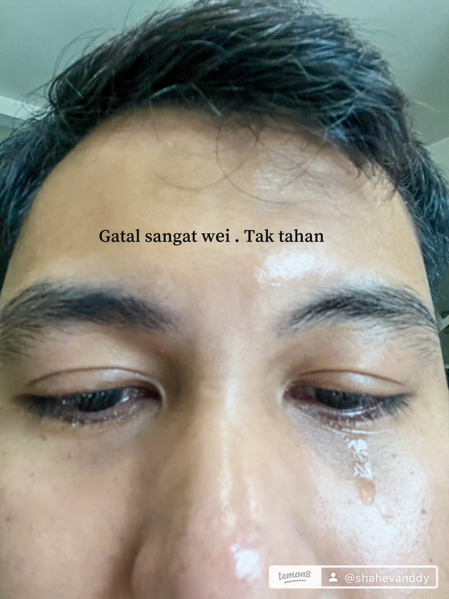 ShahEvanddy's tweet photo. Jangan pergi pantai kalau kau taknak kena gatal gatal macam ni 😥 Komen nak for thread https://t.co/BCRtj72OIb