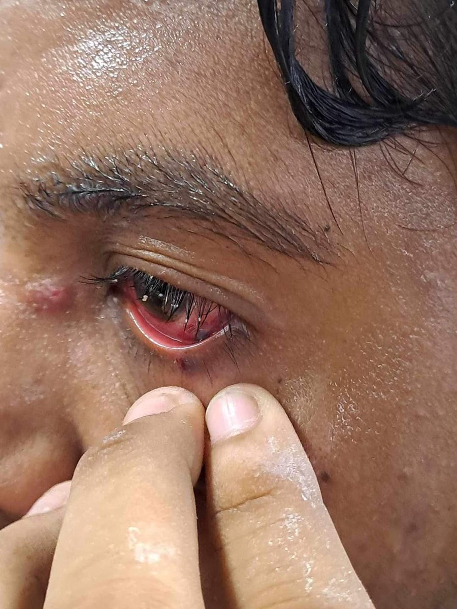 raiisdeadd's tweet image. ‼️BRAC University students getting seriously injured including their AMBULENCE DRIVER‼️
Police BGB are inhumanly torturing students for no reason
#Bangladesh 
#BDunderattack