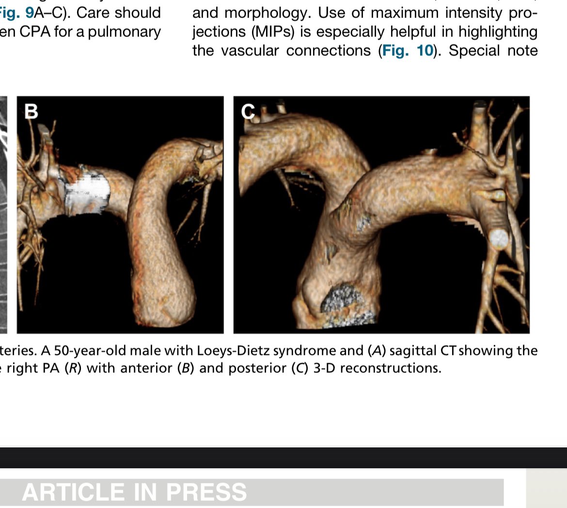 DanielVargasMD's tweet photo. Awesome to see this new paper in press! Great job by Alex Phan.  Thanks @JoannaEscalonMD for the invite to collaborate! 

#Radiology @RadClinics @WCMRadiology @COchestrads @thoracicrad @NASCISociety https://t.co/XlXuERRZpP