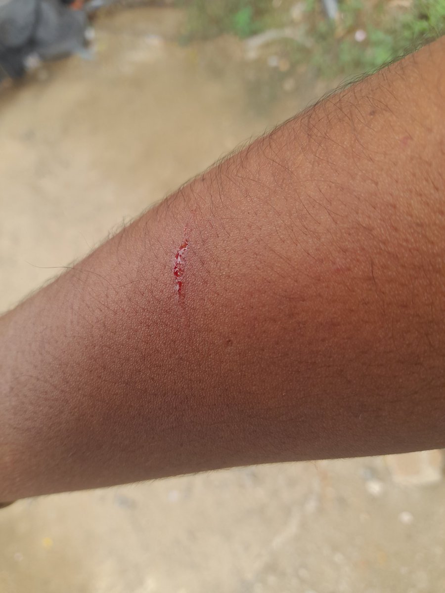 Aravind_krish97's tweet photo. @MtcChennai Today while travelling in IYI 1319 from Central to TVS I hot scratched in my hand while getting down from bus due to poor maintenance. Who will be held responsible for this?
Attaching ticket copy, scratched hand, bus photos fyr. https://t.co/Jh4ReugKZG