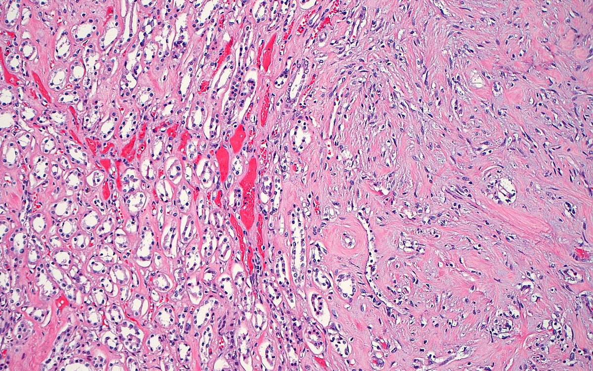 ziad_zaatari's tweet photo. Renomedullary Interstitial Cell Tumor ~ #GUpath #AutopsyPathology https://t.co/VJcRlPkSFK