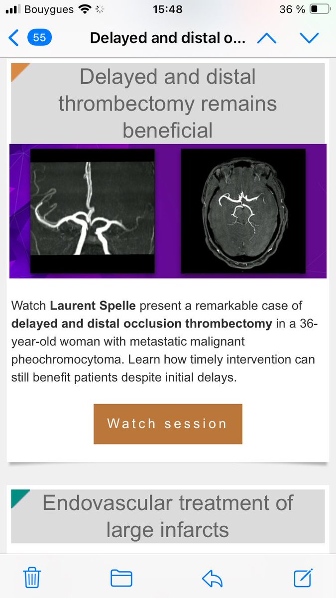 docsoph75's tweet image. Distal stroke with aspiration Technic#no stent#linnc24#P43&amp;amp;neuron max#penumbra#fast &amp;amp;furious stroke #clot first#web after? Discussion+#linnc2024
