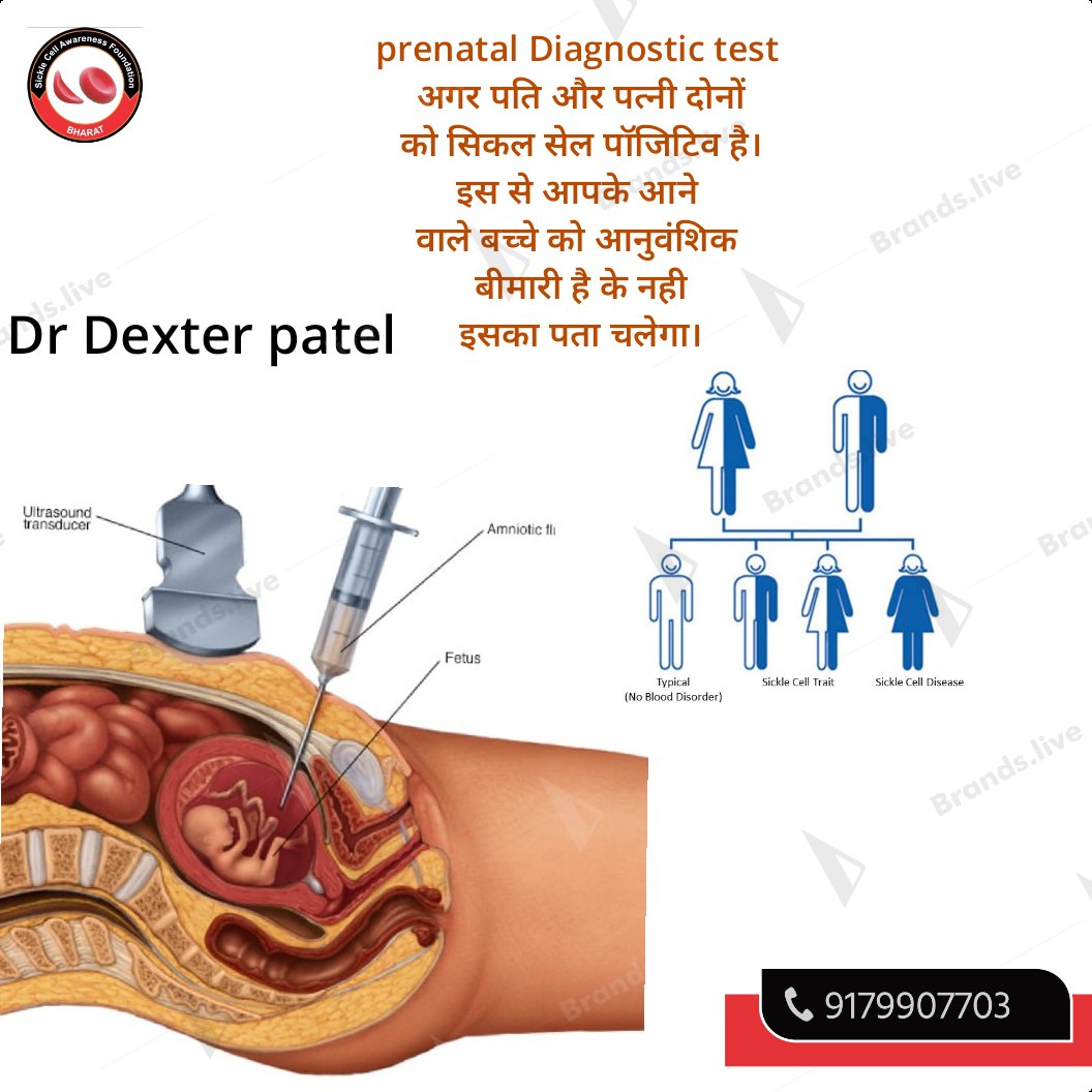 Dr Dexter(CEO-SickleCellAwarenessFoundation) (@drdexpatelscaf) on Twitter photo #sicklecelldiary..Prenatal diagnostic test is very important for prevention SCD CHILD BIRTH CONTROL <a href="/awareness_cell/">Sickle Cell Awareness Foundation</a> <a href="/TribalAffairsIn/">Ministry of Tribal Affairs, Govt. of India</a> <a href="/CMOGuj/">CMO Gujarat</a> #sicklecelldiary..Prenatal diagnostic test is very important for prevention SCD CHILD BIRTH CONTROL <a href="/awareness_cell/">Sickle Cell Awareness Foundation</a> <a href="/TribalAffairsIn/">Ministry of Tribal Affairs, Govt. of India</a> <a href="/CMOGuj/">CMO Gujarat</a>