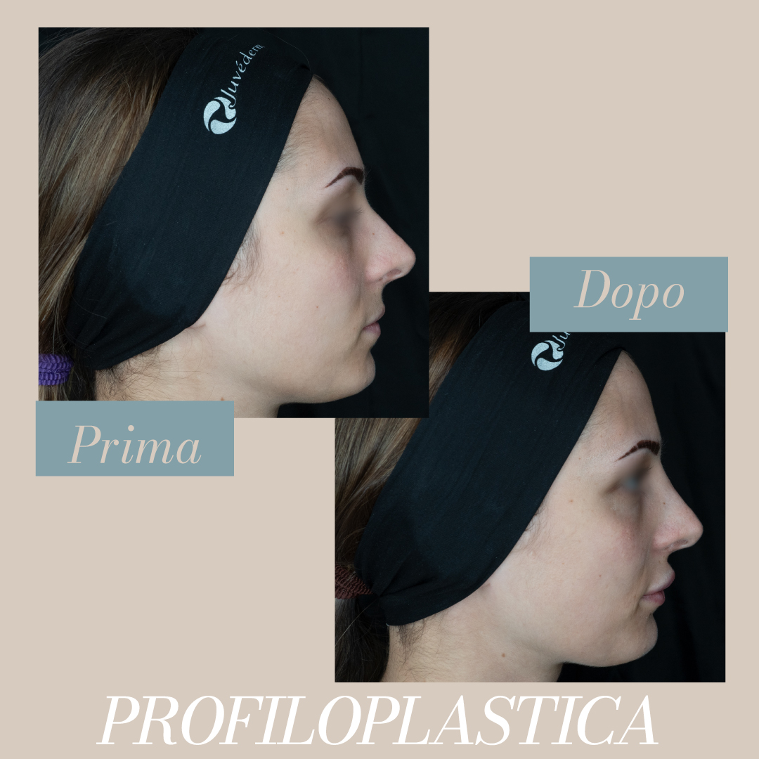 FaustoRispoli's tweet photo. La profiloplastica non chirurgica è una procedura estetica che migliora l'armonia del profilo facciale utilizzando filler dermici,  senza interventi chirurgici invasivi.
Prenota una consulenza specialistica ai seguenti recapiti
MOLISE 📞 0875703758
SICILIA 📞 0909024790 https://t.co/zSXsmzofxJ