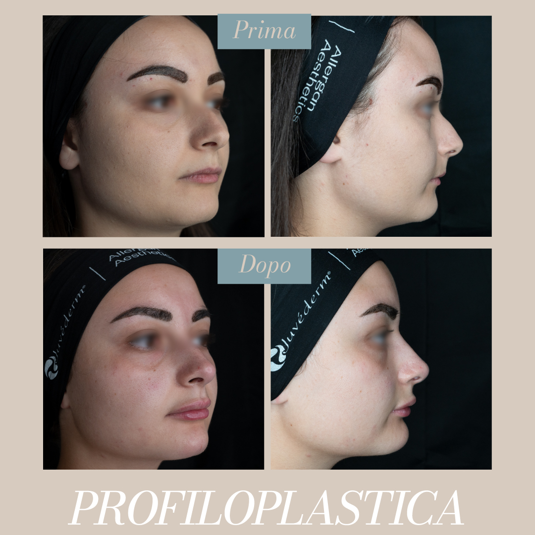 FaustoRispoli's tweet photo. La profiloplastica non chirurgica è una procedura estetica che migliora l'armonia del profilo facciale utilizzando filler dermici,  senza interventi chirurgici invasivi.
Prenota una consulenza specialistica ai seguenti recapiti
MOLISE 📞 0875703758
SICILIA 📞 0909024790 https://t.co/zSXsmzofxJ