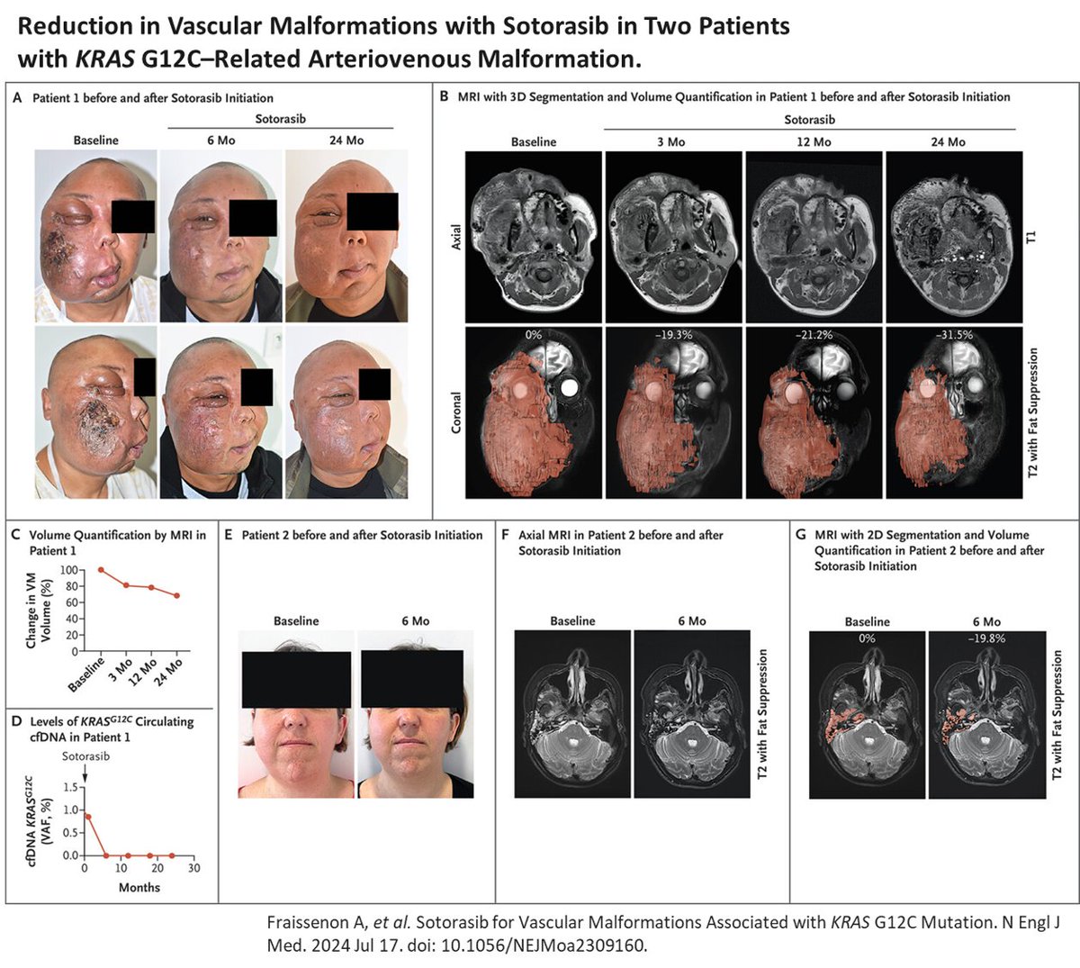 🚨 New publication in <a href="/NEJM/">NEJM</a> showcases promising results for treating KRAS G12C-related AVMs! Rapid symptom relief &amp; significant size reduction in AVMs.
A huge leap forward in patient care! Kudos to everyone involved! 🙌🎉 <a href="/CanaudLab/">Guillaume Canaud (MD, PhD)</a>  

🔗Read more: nejm.org/doi/full/10.10…