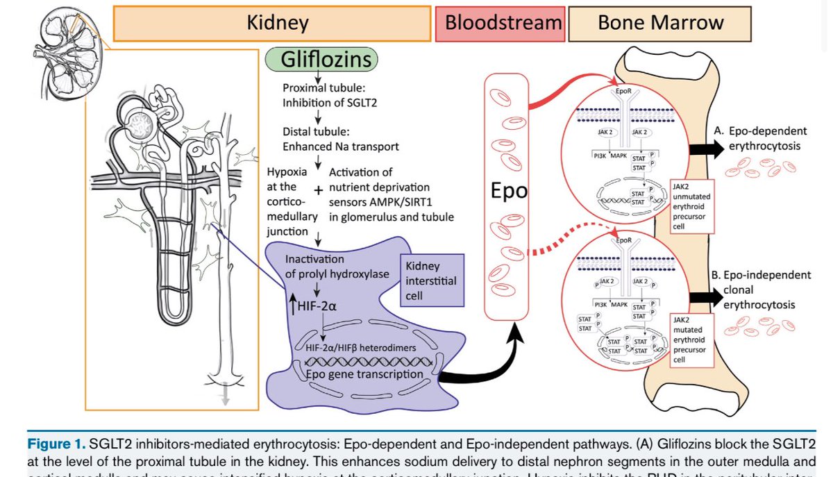 JonathanNefro's tweet photo. La aparición de eritrocitosis (Hgb >16.5g) por iSGLT2:

•Dependiente de eritropoyetina por hipoxia renal 
•Desenmascara policitemia vera y Hemocromatosis

En algunos casos amerita la evaluación por Hematologia y tratarla

AJKD 2024
10.1053/j.ajkd.2024.02.015 https://t.co/1KwGRp18jo