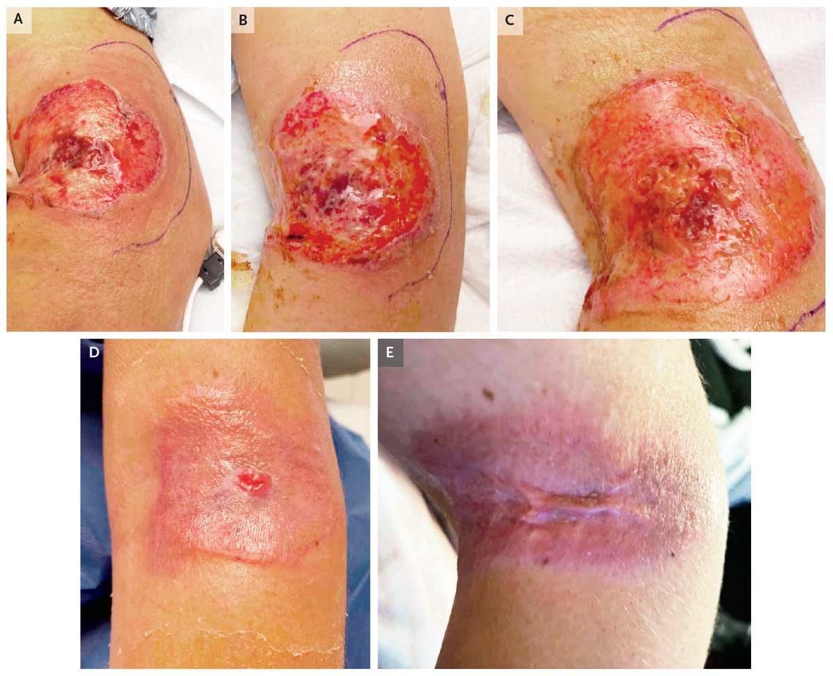 In the latest Case Record of the MGH, a 30-year-old woman was admitted 6 days after the birth of her first child because of fever and abdominal pain. New skin ulcers were noted. A diagnosis was made. Read the full clinical case: nej.md/465Fh4F