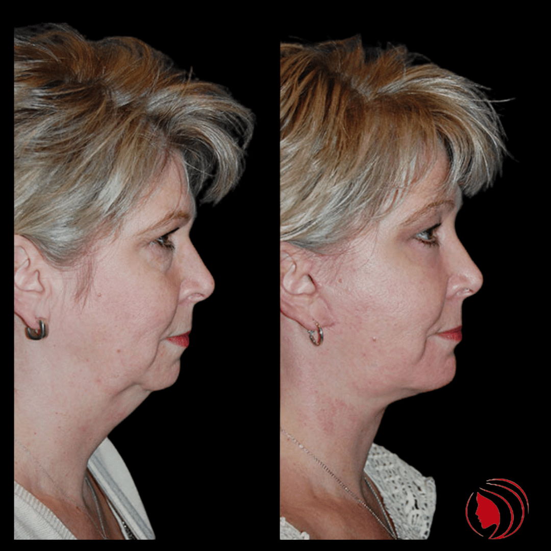 OnlyFacesCLT's tweet photo. This 55-year-old is post-op from a Segmental Endoscopic #BrowLift: aggressive 3/4-R/L, Deep Plane #Facelift, Lower Lid: #SOOF lift #blepharoplasty, #ChinImplant, and Ablative CO2 Laser Resurfacing of the eyes and mouth. #Makeover #OnlyFaces https://t.co/E12SoqDPSB