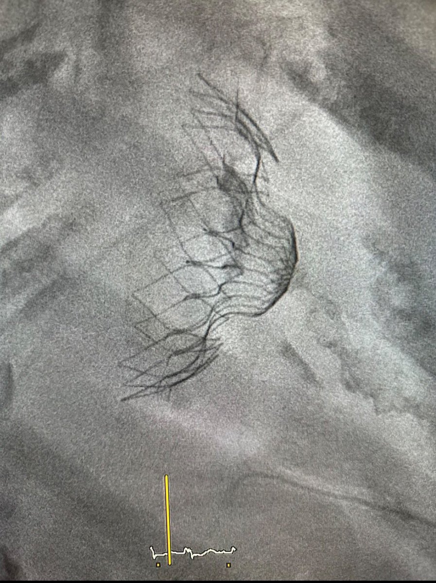 thomas modine (@modine_thomas) on Twitter photo FIM implant to treat #tricuspid regurgitation.
@VersaVascular implanted for the first time in human!!!
@CCN & @CHUdeBordeaux. 🤜🏼🤛🏼
Great echo guidance @JulienDreyfus
@JuanGranada <a href="/lionelleroux/">Lionel Le Roux</a> <a href="/LouisLabrousse/">louis labrousse</a> 🫶🏼
Great work done 💪🏼💪🏼
Easy, fast &safe @MaggieNixon FIM implant to treat #tricuspid regurgitation.
@VersaVascular implanted for the first time in human!!!
@CCN & @CHUdeBordeaux. 🤜🏼🤛🏼
Great echo guidance @JulienDreyfus
@JuanGranada <a href="/lionelleroux/">Lionel Le Roux</a> <a href="/LouisLabrousse/">louis labrousse</a> 🫶🏼
Great work done 💪🏼💪🏼
Easy, fast &safe @MaggieNixon