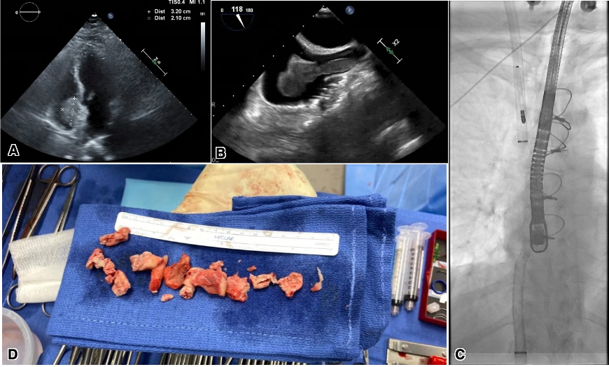 New case with videos! “Combining Novel Thrombectomy Devices for Intracardiac Mass Extraction: The Kong and Godzilla of Mass Extraction” <a href="/HTHennawi/">Hussam Al Hennawi</a> <a href="/MohammedQintar/">Mohammed Qintar, MD MSc</a> <a href="/UMHealthSparrow/">University of Michigan Health-Sparrow</a>

#DeBakeyCVJournal doi.org/10.14797/mdcvj…
<a href="/maquinonesmd/">M Quinones MD, MACC</a> <a href="/NadeenFaza/">Nadeen N. Faza, M.D.</a> <a href="/CardioNerds/">CardioNerds</a> <a href="/HMHCardioFellow/">Houston Methodist Cardiovascular Fellowships</a>