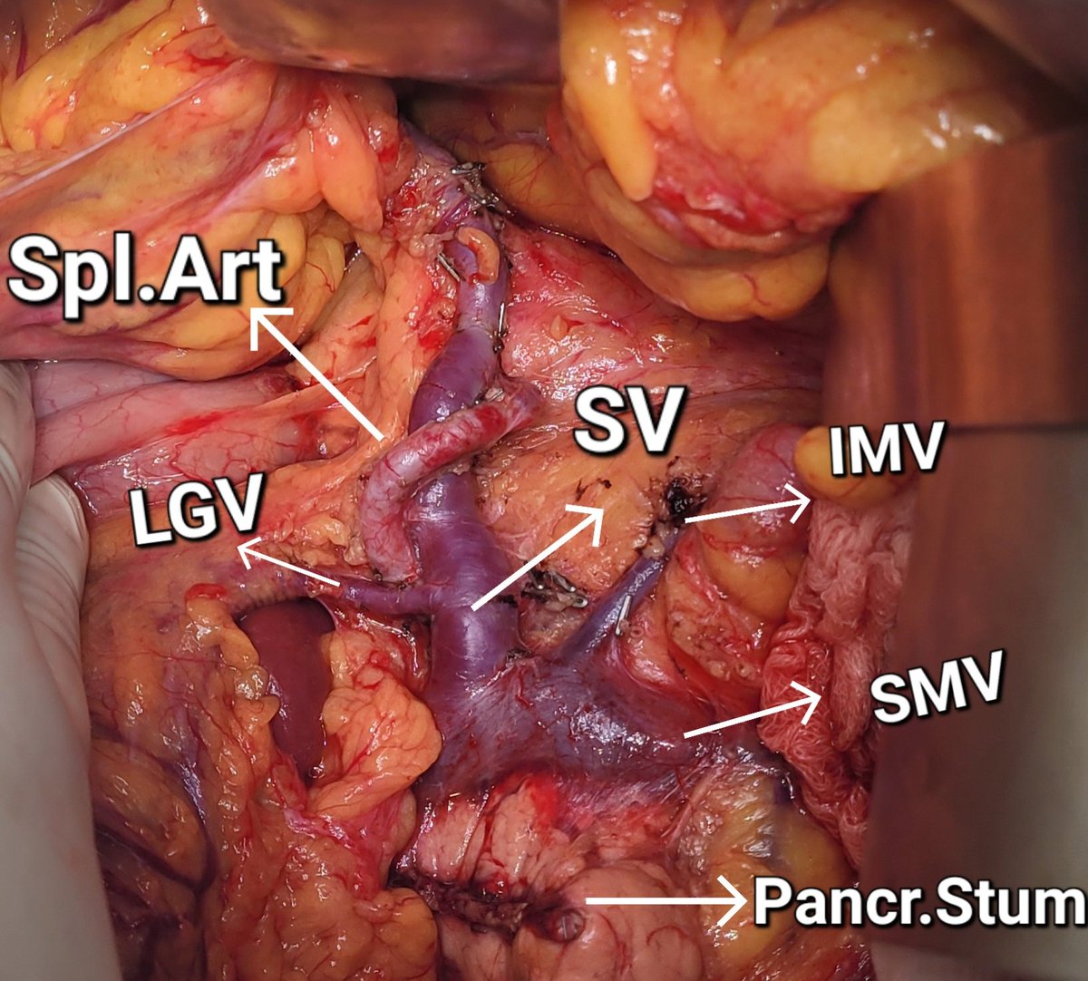 Mayank_Oncology's tweet photo. Surgical bed after Spleen preseving distal pancreatectomy for a cystic neoplasm of pancreas. If you zoom in you can see the dorsal pancreatic branch from SA
@IHPBA @EAHPBA @AHPBA @SyedAAhmad5 @SanjayGovil8 @sanjay_HPB @the_nuclear_doc @TMC_Varanasi https://t.co/gZnZb9By61