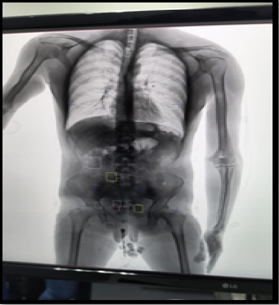 #Callao 🚨| ¡La droga tenía destino final Italia!
Efectivos del <a href="/AeropuertoLima/">Aeropuerto de Lima Jorge Chávez</a> detuvieron a un sujeto implicado en el TID, 
al trasladar sustancias tóxicas en cápsulas bajo las modalidades de momia e ingesta hacia la ciudad de Madrid, España.
#PerúSeguro🚔🇵🇪