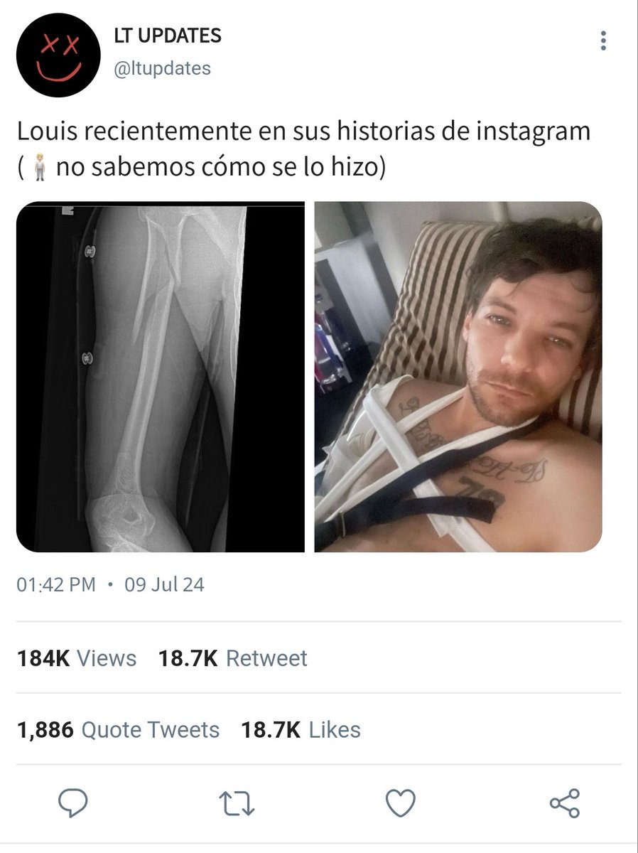 tloulthsmx28's tweet photo. Mini au Larry- sickfic #concurso_sickfics 

Dónde el famoso cantante L'ouis T'omlinson sufre un accidente cuando esta jugando una carrera 
O
Dónde el malhumorado Dr S'tyles atiende a un cantante que se quebró el brazo https://t.co/cpAnRS3D9c