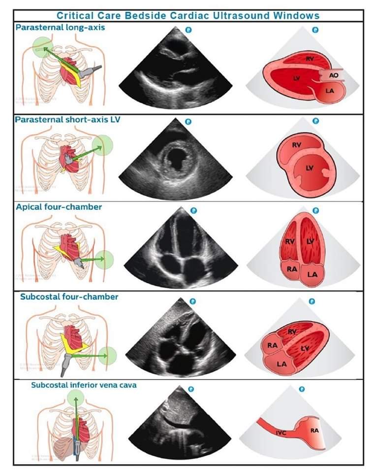 ZHeart11768530's tweet photo. 🔴Basic Cardiac Ultrasound Windows 🔹

Image courtesy: Philips Healthcare 
#FOAMed #FOAMcc #SCCMSoMe #ICU 
 #CVD #medical  #cardiology #medicine #emergency #ECG #ekg #meded #MedX #CardioEd #CardioTwitter #medtwitter #cvd #ecg #Medtwitter https://t.co/z6JNxy09zX