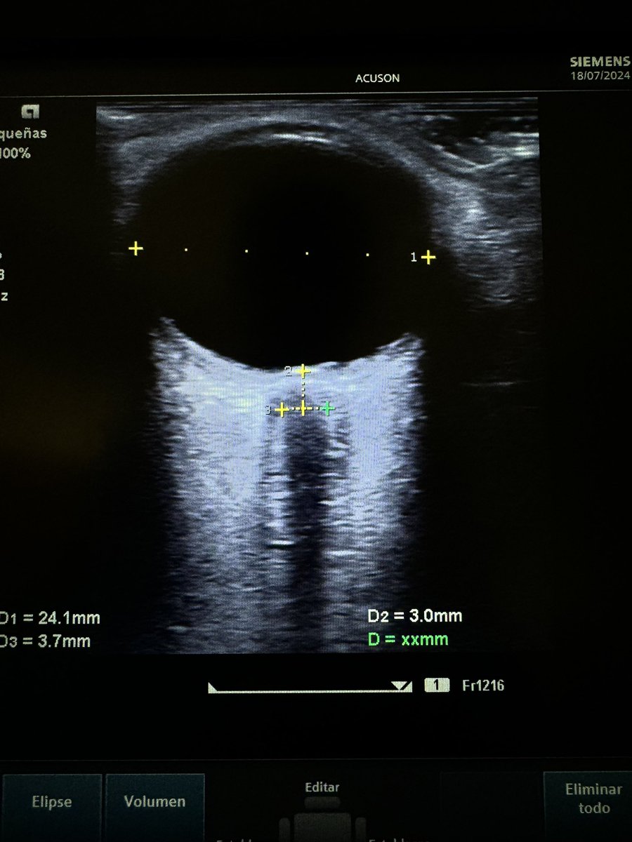 FcoAyusoMC's tweet photo. Cuidados Neuricriticos. 🧠
PIC estimada 12.82 mmHg. 
Por Fórmula: PIC = (VNO mm x 5.69) - 8.23

DTGO: Diámetro transverso de globo ocular 👁️. 

Plus VNO/DTGO : 0.15 

Menor a 0. 18 = PIC menor a 20 mmHg. https://t.co/VDNxwqkZza