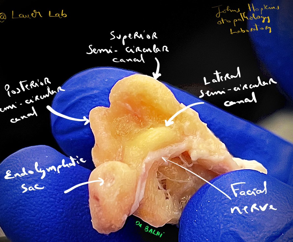 Human Temporal bone dissection 👂 
I think I’ve put a lot of love into this one ❤️ 

@LauerLab <a href="/WardensMD/">Bryan Ward</a> <a href="/hopkins_ent/">Johns Hopkins OHNS</a> 
#otopathology #otology #neurotology