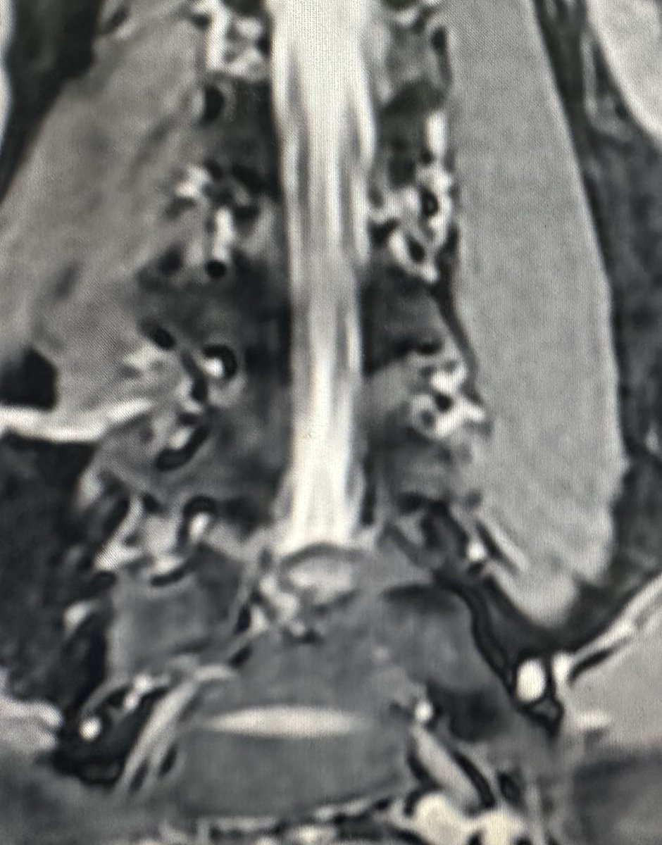 ChavezRamzes's tweet photo. Type of herniated disk?
Treatment?

This was today's case https://t.co/c2zdwprb3j