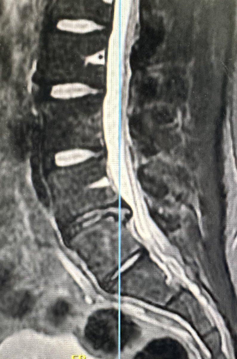 ChavezRamzes's tweet photo. Type of herniated disk?
Treatment?

This was today's case https://t.co/c2zdwprb3j