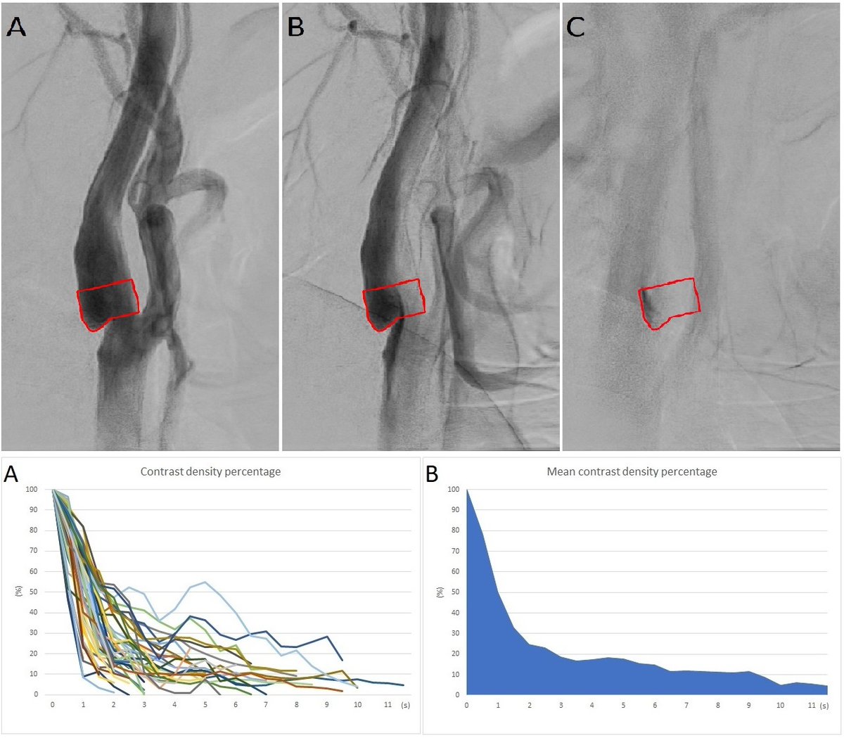Mateus Damiani Monteiro (@mateusdamiani) on Twitter photo Contrast stagnation time and carotid web morphological features. Check out our new paper:
jnis.bmj.com/content/early/…
<a href="/Mo_TarekNeuro/">Mohamed Ahmed Tarek</a> <a href="/PedroNMartins__/">Pedro Martins</a> <a href="/JayDoliaMD/">Jay Dolia MD</a> <a href="/RaulNogueiraMD/">Raul G Nogueira, MD, FAHA, FSVIN</a> <a href="/DiogoHaussen/">Diogo Haussen</a> <a href="/EmoryStroke/">Emory & Grady Vascular Neurology</a> <a href="/JNIS_BMJ/">JNIS</a> Contrast stagnation time and carotid web morphological features. Check out our new paper:
jnis.bmj.com/content/early/…
<a href="/Mo_TarekNeuro/">Mohamed Ahmed Tarek</a> <a href="/PedroNMartins__/">Pedro Martins</a> <a href="/JayDoliaMD/">Jay Dolia MD</a> <a href="/RaulNogueiraMD/">Raul G Nogueira, MD, FAHA, FSVIN</a> <a href="/DiogoHaussen/">Diogo Haussen</a> <a href="/EmoryStroke/">Emory & Grady Vascular Neurology</a> <a href="/JNIS_BMJ/">JNIS</a>