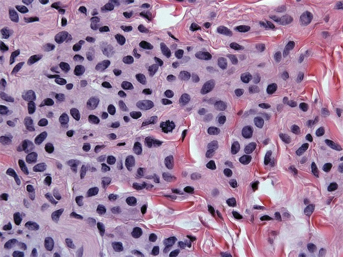 AJDP_Journal's tweet photo. #ThrowbackThursday 
Nevic Mitoses: A Review of 1041 Cases

This study in 2013 concluded that mitotic figures, even multiple ones, do not preclude benignity in a variety of melanocytic nevi.
https://t.co/eu0vuBRxIT
What are your thoughts? https://t.co/l91Jk4gxPR