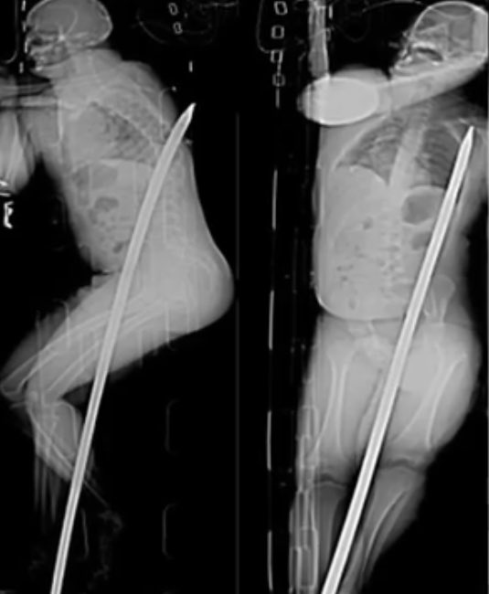 MorbidKnowledge's tweet photo. In January 2015, Daniel De Wet, an engineering supervisor, was working on cleaning out a dam located 3.5 kilometers underground at a mine in South Africa. While using an extended crowbar to stir up the mud, De Wet suddenly slipped and fell onto the rod. 

Looking down in shock, he realized that the 5ft metal bar had pierced his body, entering through his groin area and exiting just below his shoulder blade.

After being extricated from the mineshaft, he was swiftly transported to a hospital where surgeons meticulously extracted the massive rod. 

The injuries were severe but significantly less catastrophic than they might have been. The rod obliterated one of his kidneys and inflicted damage on his small intestine. 

Remarkably, he recuperated rapidly and was released from the hospital only 19 days after the incident.