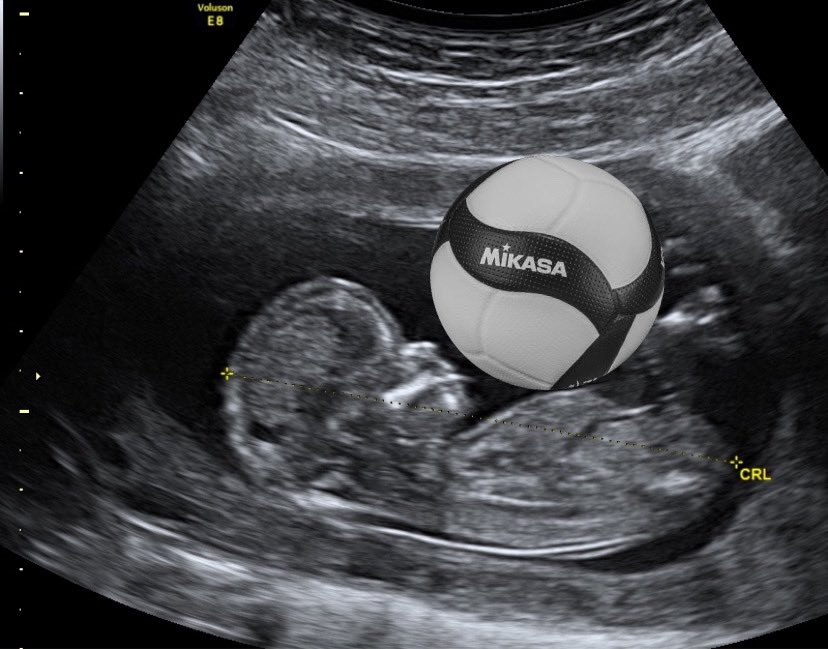 hyatsum's tweet photo. real ultrasound of kageyama tobio (not clickbait) https://t.co/5U3TctpeyT