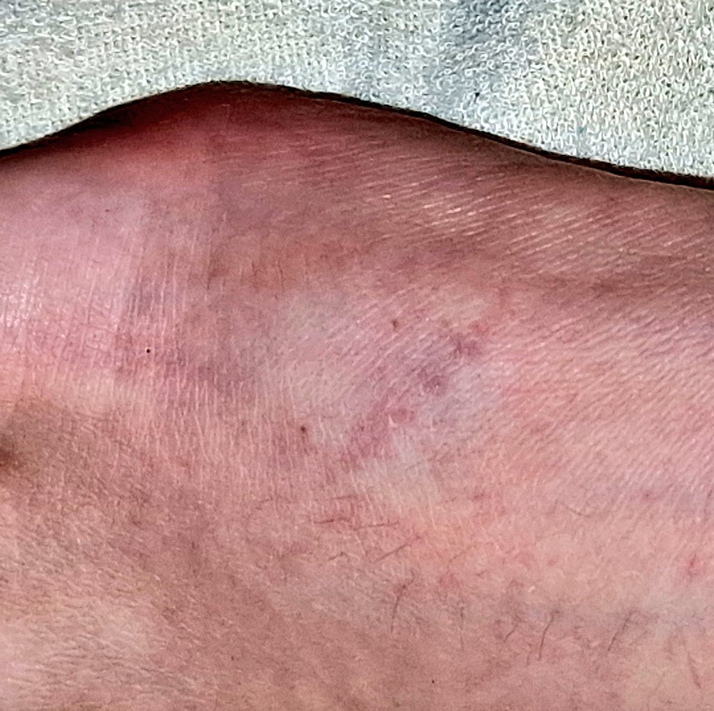 VixRoseGemB's tweet photo. Well.... I did a stupid thing 🤦‍♀️
Recently, I brought new parasol for the garden &amp; accidently dropped the 8kg concrete base on my foot yesterday 😱 #plonker 
Did #NHS111 online Told to go to Urgent Care. 
Visited @WestHertsNHS #watfordgeneral site today to get checked over...

1/2 https://t.co/wfBMfyZ2uR