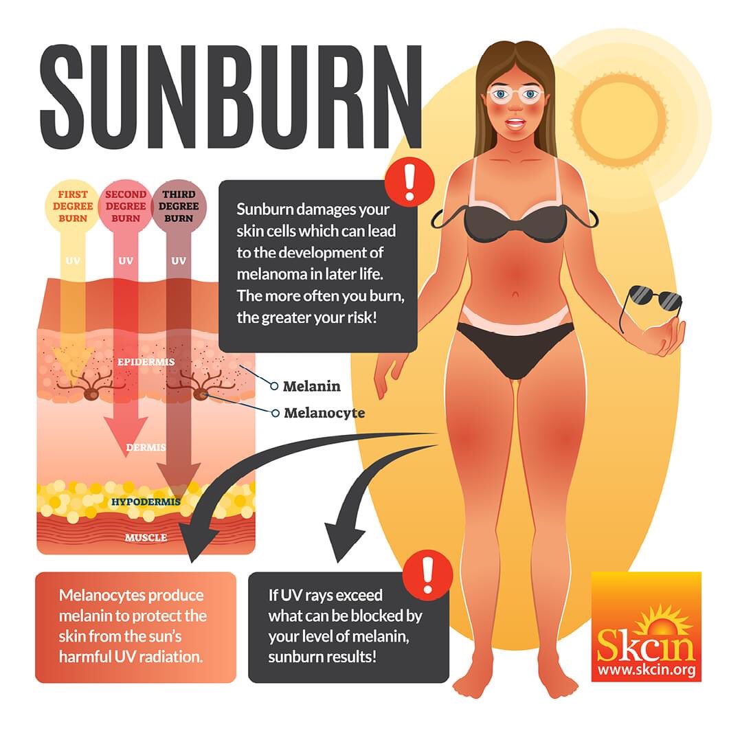 ‼ SUNBURN, REDDENING, PEELING AND EVEN TANNING OF THE SKIN IS CLEAR INDICATION OF SUN DAMAGE. OVER-EXPOSURE TO UVA AND UVB CAUSES DNA CELL DAMAGE THAT CAN LEAD TO ALL TYPES OF SKIN CANCER.