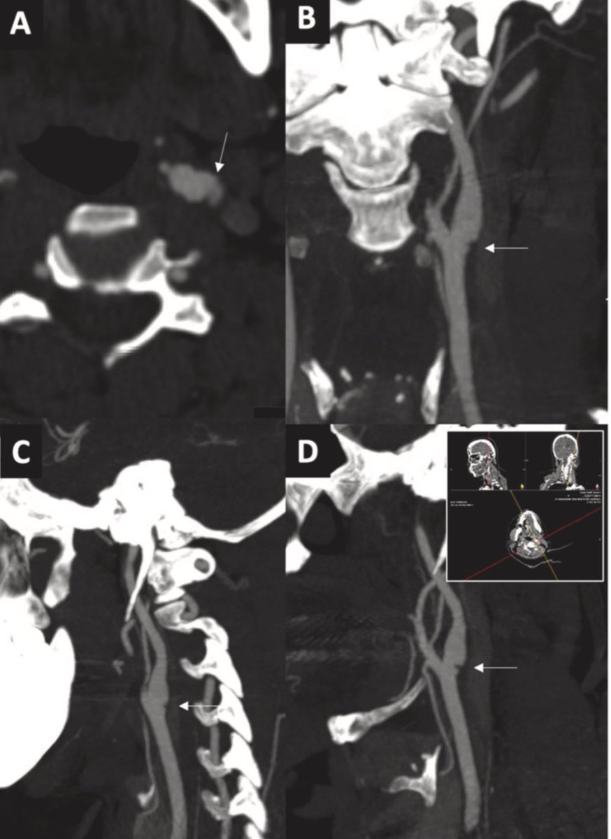 Diogo Haussen (@diogohaussen) on Twitter photo Multiplane reconstruction modifies the diagnostic performance of CTA in carotid webs. One image is no image when talking webs <a href="/Nirav_r_bhatt/">Nirav Bhatt</a> <a href="/AlAlBayati1/">Alhamza R. Al-Bayati, MD</a> <a href="/RaulNogueiraMD/">Raul G Nogueira, MD, FAHA, FSVIN</a> <a href="/JAGrossbergMD/">Jonathan A. Grossberg</a> <a href="/EmoryStroke/">Emory & Grady Vascular Neurology</a> <a href="/GradyHealth/">GradyHealth</a> <a href="/lorena_neuro/">Lorena Viana</a> Multiplane reconstruction modifies the diagnostic performance of CTA in carotid webs. One image is no image when talking webs <a href="/Nirav_r_bhatt/">Nirav Bhatt</a> <a href="/AlAlBayati1/">Alhamza R. Al-Bayati, MD</a> <a href="/RaulNogueiraMD/">Raul G Nogueira, MD, FAHA, FSVIN</a> <a href="/JAGrossbergMD/">Jonathan A. Grossberg</a> <a href="/EmoryStroke/">Emory & Grady Vascular Neurology</a> <a href="/GradyHealth/">GradyHealth</a> <a href="/lorena_neuro/">Lorena Viana</a>
