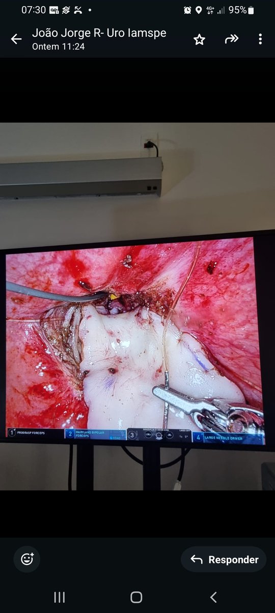 Post Turp bladder neck

Robotic Subtrigonal BMG