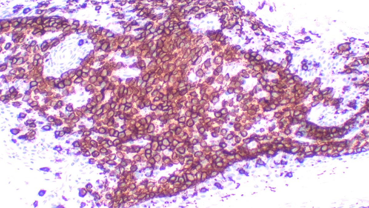 Int Soc Dermpath (@intsocdermpath) on Twitter photo #ISDP #OlympicGames
Spot diagnosis
Case 12 - <a href="/JCandidoXavier/">Jose Candido</a>
LANGERHANS CELL HISTIOCYTOSIS
• Round/ovoid medium-sized cells with indented, lobulated or coffee-bean nuclei.
• Abundant and eosinophilic cytoplasm
•IHQ markers: CD1a, Langerin and S100 protein
#derm #path #ISDP #OlympicGames
Spot diagnosis
Case 12 - <a href="/JCandidoXavier/">Jose Candido</a>
LANGERHANS CELL HISTIOCYTOSIS
• Round/ovoid medium-sized cells with indented, lobulated or coffee-bean nuclei.
• Abundant and eosinophilic cytoplasm
•IHQ markers: CD1a, Langerin and S100 protein
#derm #path