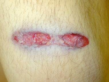 @mikenov: Defining forensic characteristics of grazing or tangential AR-15 gunshot wounds on photographs