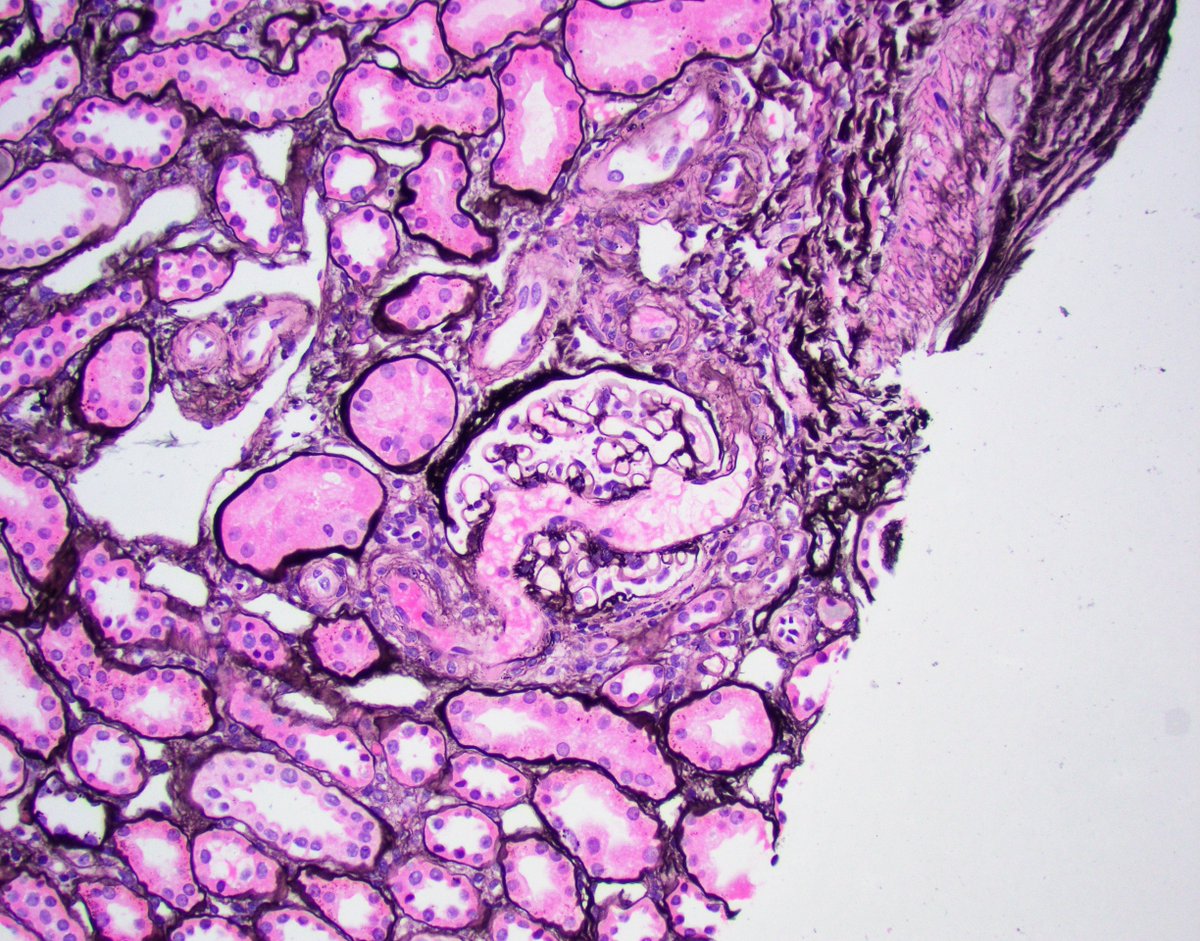 Afferent-efferent connection? #renalpath #nephrology #pathwtitter