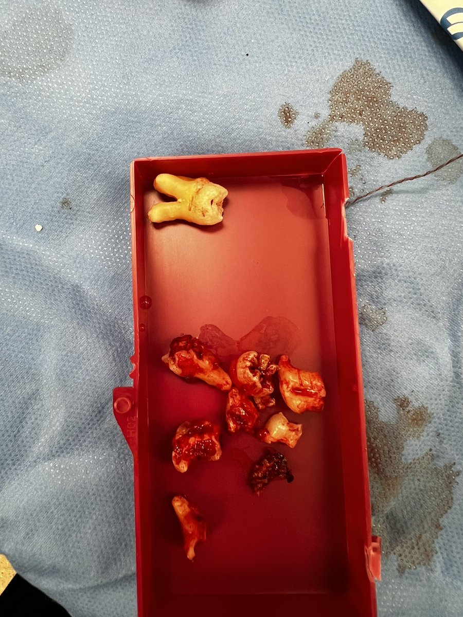 ozenik062's tweet photo. Difficult extraction 😅 https://t.co/giURB8rqci