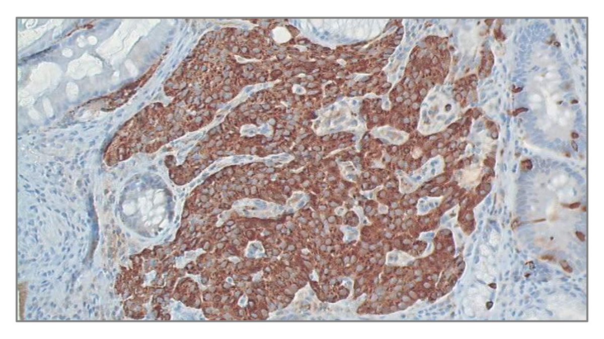 🎓 Inscrivez-vous au DIU Tumeurs neuroendocrines de <a href="/GustaveRoussy/">Gustave Roussy</a>, <a href="/UnivParisSaclay/">Université Paris-Saclay</a> et <a href="/univ_paris_cite/">Université Paris Cité</a>.

Il propose une formation complémentaire et fait appel à des compétences en biologie, imagerie, génétique, chirurgie, et bien d’autres.

tinyurl.com/2zb5jbjd

#cancer