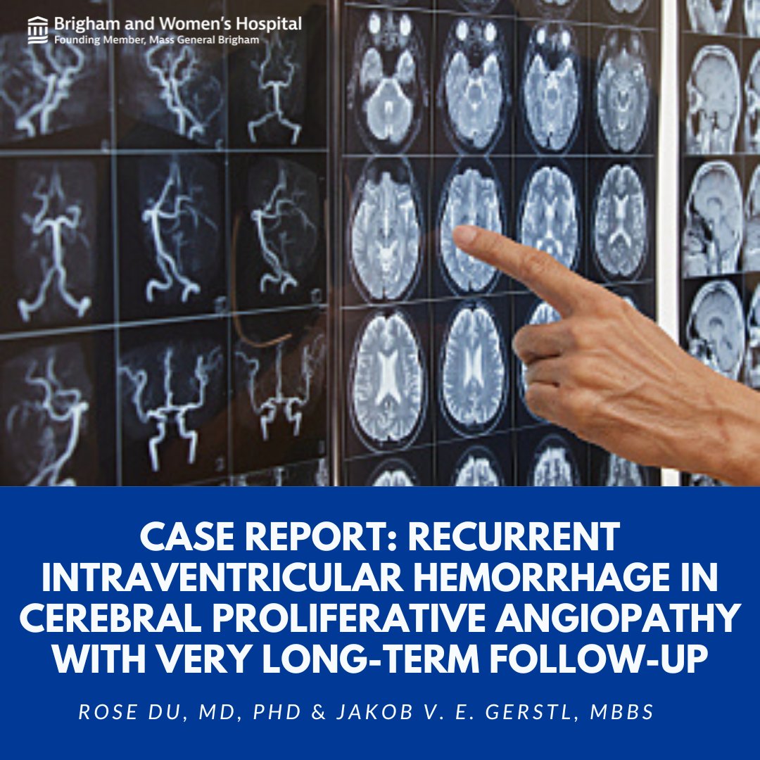 Brigham and Women's Neurosurgery (@bwhneurosurgery) on Twitter photo Explore the latest case report by <a href="/JakobGerstl/">Jakob Gerstl</a>, MBBS, and Rose Du, MD, PhD, on recurrent intraventricular hemorrhage in cerebral proliferative angiopathy. Their long-term follow-up offers crucial insights. Read more: brighamhealthonamission.org/2024/02/29/cas… Explore the latest case report by <a href="/JakobGerstl/">Jakob Gerstl</a>, MBBS, and Rose Du, MD, PhD, on recurrent intraventricular hemorrhage in cerebral proliferative angiopathy. Their long-term follow-up offers crucial insights. Read more: brighamhealthonamission.org/2024/02/29/cas…